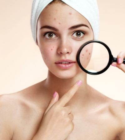 Tratamiento de Acné